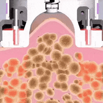 Cupnova – Anti-Cellulite Massager | 50% KORTING