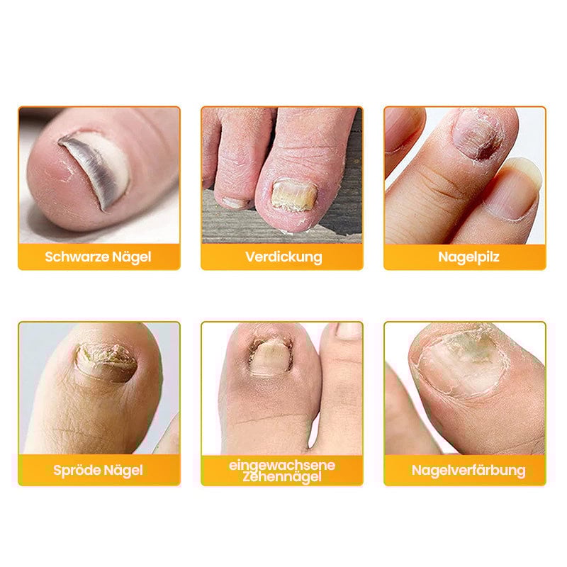 FungiPatch™ 60+60 stuks  – Discrete Behandeling van Schimmelnagels | 50% KORTING