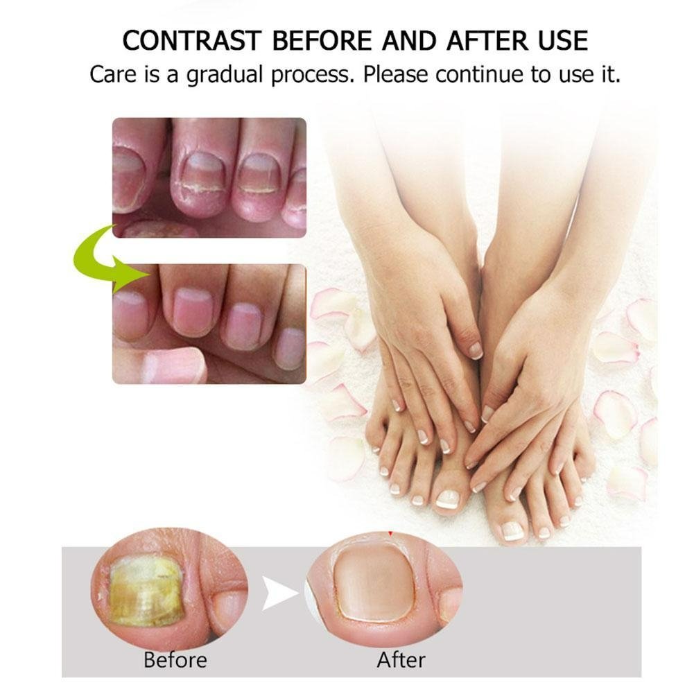 1+1 gratis | Nagelreparatie | Snelle en effectieve resultaten!