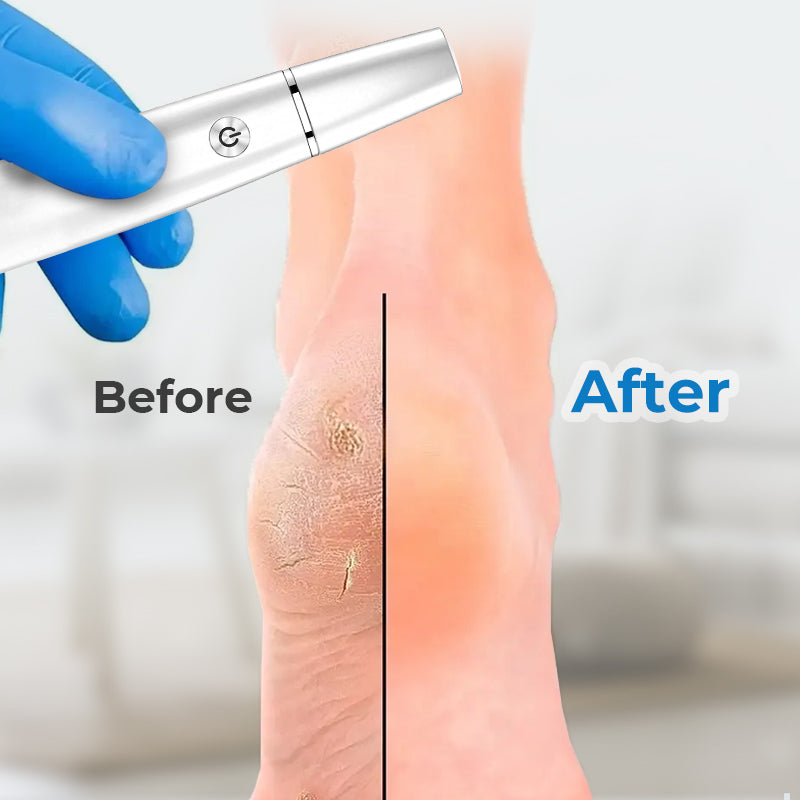 Elektrische eeltverwijderaar voor voeten