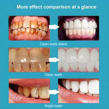 BrightSmile™ Tandenbleekpen | 1+1 GRATIS