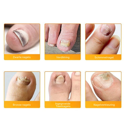FungiPatch™ 60+60 stuks  – Discrete Behandeling van Schimmelnagels | 50% KORTING