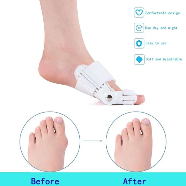 SoleAlign Bunion Oplossing – Dagelijkse Pijnvrije Stappen