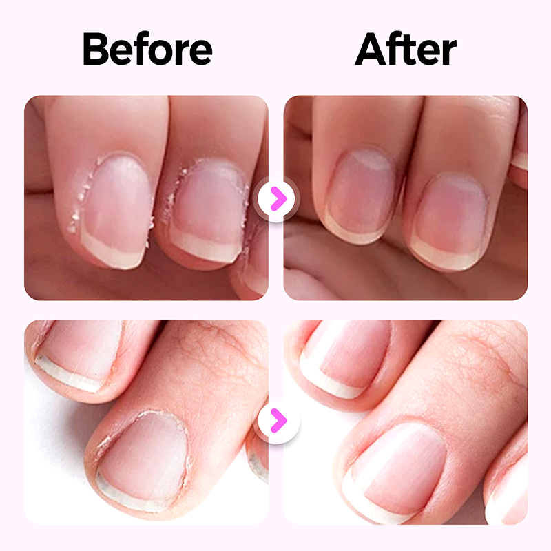 NailCare – 3-in-1 Nagelpen | 1+2 GRATIS